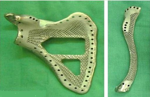 3d打印應用領域之醫(yī)療應用_e鍵打印服務公司 3d打印應用領域之醫(yī)療應用_e鍵打印服務公司