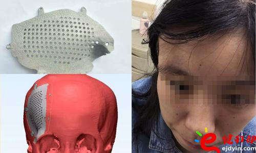 醫療3d打印應用,醫用3d打印,3D打印假肢,3D打印脊椎,3D打印心臟,e鍵打印,3d打印服務 3D打印的顱骨假體，非常適用于發際外的顱骨缺損、病變置換，將使患者的面容恢復到正常形態，完美解決了傳統顱骨修補存在的美容問題。據悉，3D打印個性化顱骨假體修補技術已獲國家重點研發計劃資助，能為一批病人免費提供假體，并能減免一些檢查和治療費用。未來將實行72小時的3D假體個性化顱骨修補術，造福更多的患者。